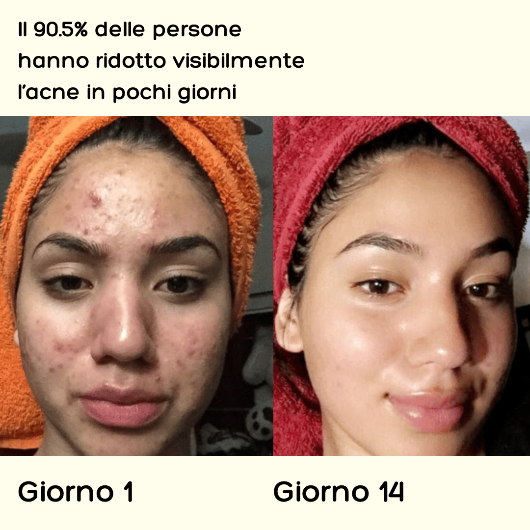 crema-anti-acne-e-rossori